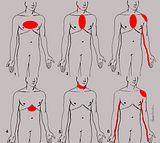 th_Angina_Illustrations.jpg?t=1329194942