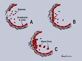th_Plaque_Formation_Final.jpg?t=13292383